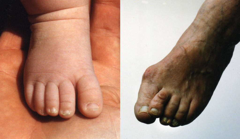 Baby's foot and Bunioned foot.jpg